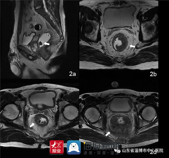病变|淄博市中心医院放射科巧用耦合剂灌肠行高分辨率MRI精准诊断