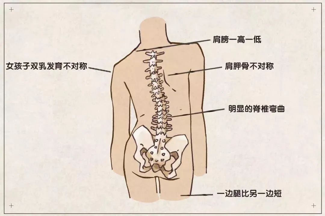 脊柱侧弯|S型曲线？不，有可能是脊柱侧弯！来看解答→