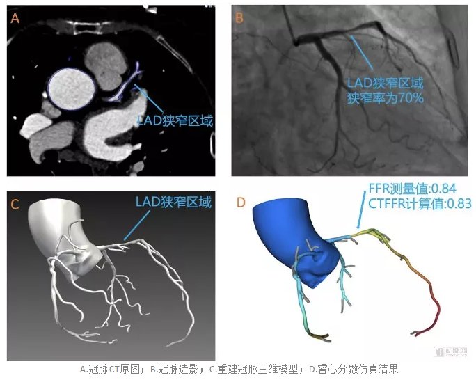 功能学|【健哥说心脏】CT-FFR技术，为什么靠谱？