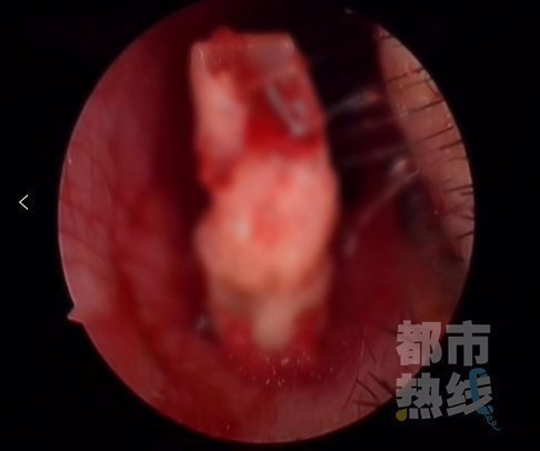 王延辉|一6岁女童鼻子里“长牙”,取出后发现竟是三年前失踪的门牙