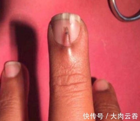 指甲|男子的指甲上长出“小手指”,去医院检查后,医生也是第一次看到