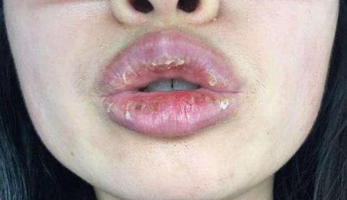 嘴唇总是干裂没亮泽？不只是缺水，还跟缺乏一种营养素有关