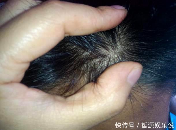 头皮上有白色的东西，很多人都喜欢抠，这些到底是什么东西？