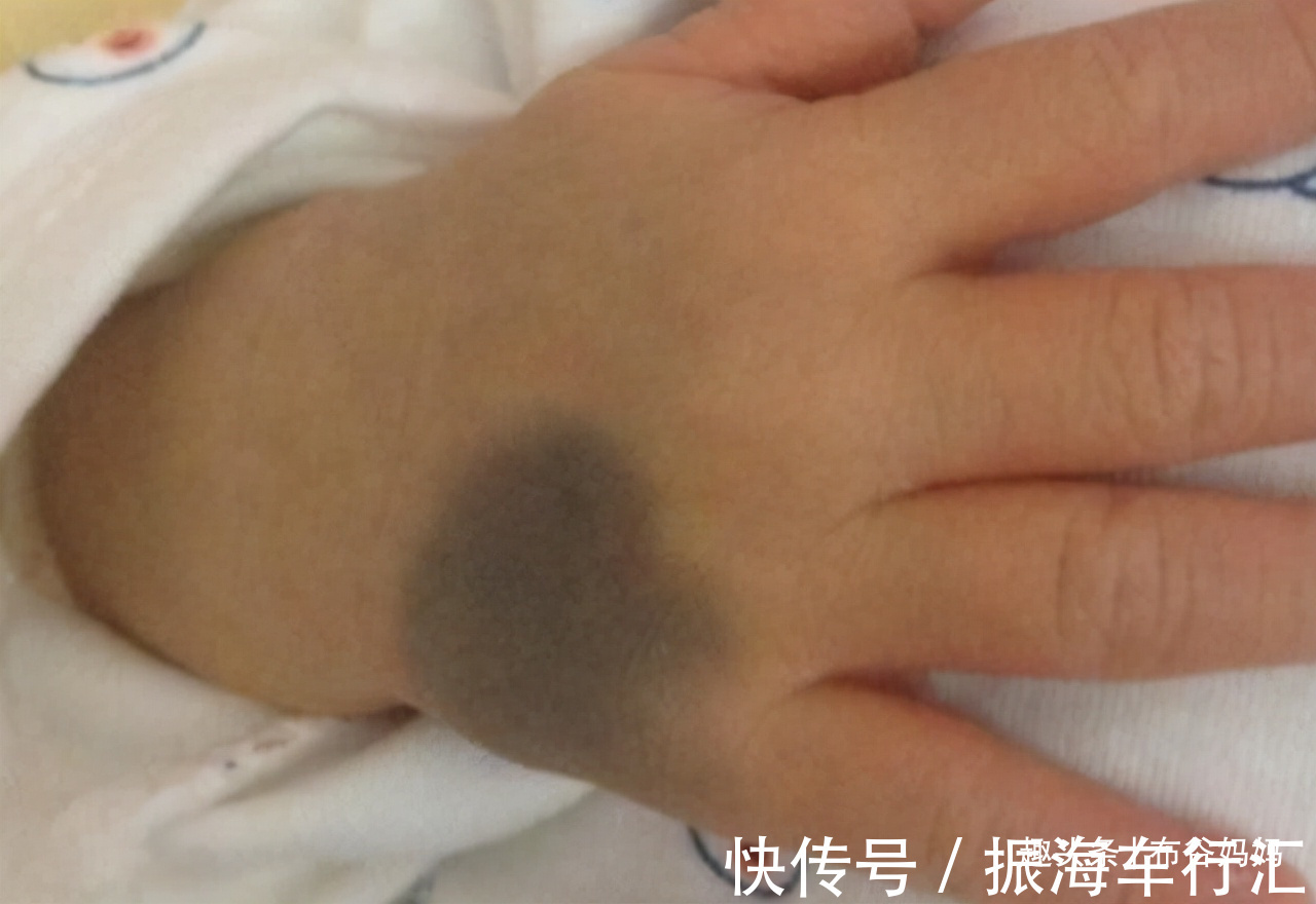 孕期|胎记是怎么来的?产科医生:孕期要避开3种行为,以免宝宝长胎记