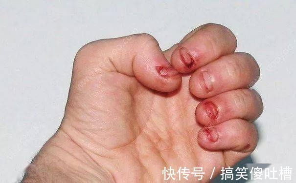 小孩出現(xiàn)撞頭、咬指甲、撕嘴皮等行為,媽媽一定要警惕了