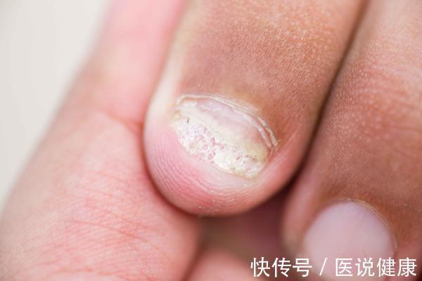 肝脏|肝不好，指甲知道！指甲若有6种表现，或是肝脏“病”了