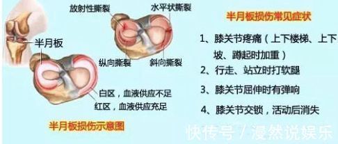 事儿|运动后，你的半月板还好么关于半月板的这点儿事儿！