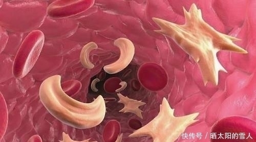 心脑血管|大蒜与它一起吃,胜过“他汀药”,经常吃点,高血脂不攻自破