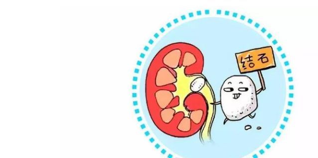 软坚|结石?三味中药,软坚,消石,排石