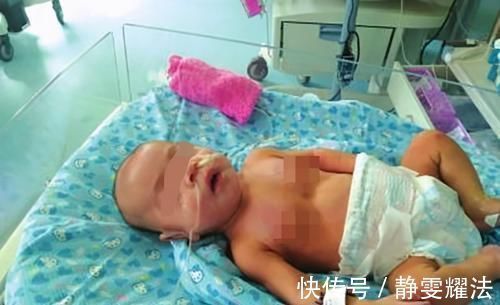 消化器官|五个月女婴双肾长满结石,只因刚出生三天,父母就开始做这件事