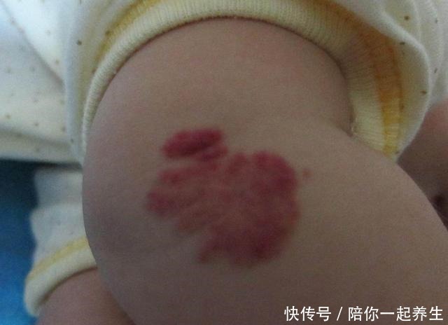 新生儿手臂生出“草莓斑”,宝妈以为碰了,医生检查后说要手术!