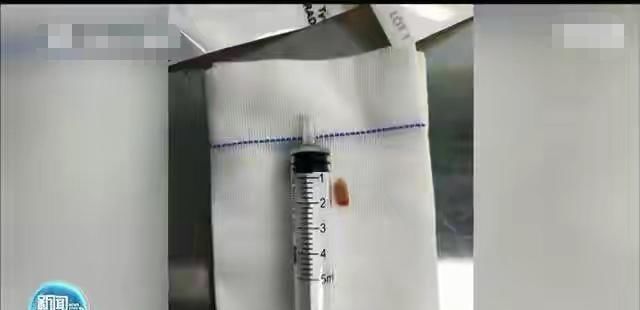 喂食|粗心家长喂食八个月婴儿排骨,导致窒息婴儿命悬一线