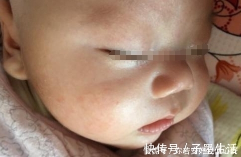 湿疹|25岁产妇剖宫产后坐月子,天气太冷只顾保暖,结果宝宝成了这样