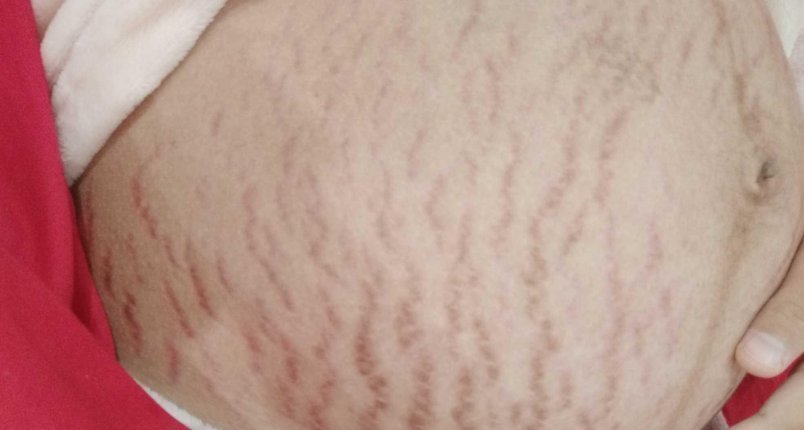 怀孕|怀孕7个月的孕妈每天抹油,但还是长了妊娠纹,医生的一句话扎心了