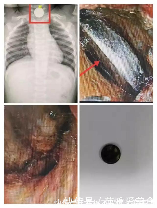 毒物|小小一枚,孩子喉管被腐蚀!再说一遍,这些东西必须放好了