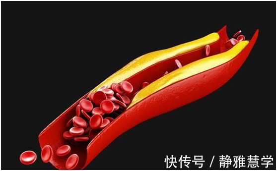 疾病|患上高血脂的危害有哪些好好学习，全都是知识点呢