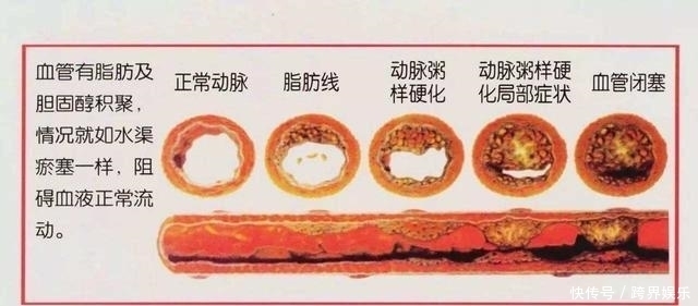 甘油三酯偏高，3种食物需“忌口”，若你爱吃，血管或加速变堵