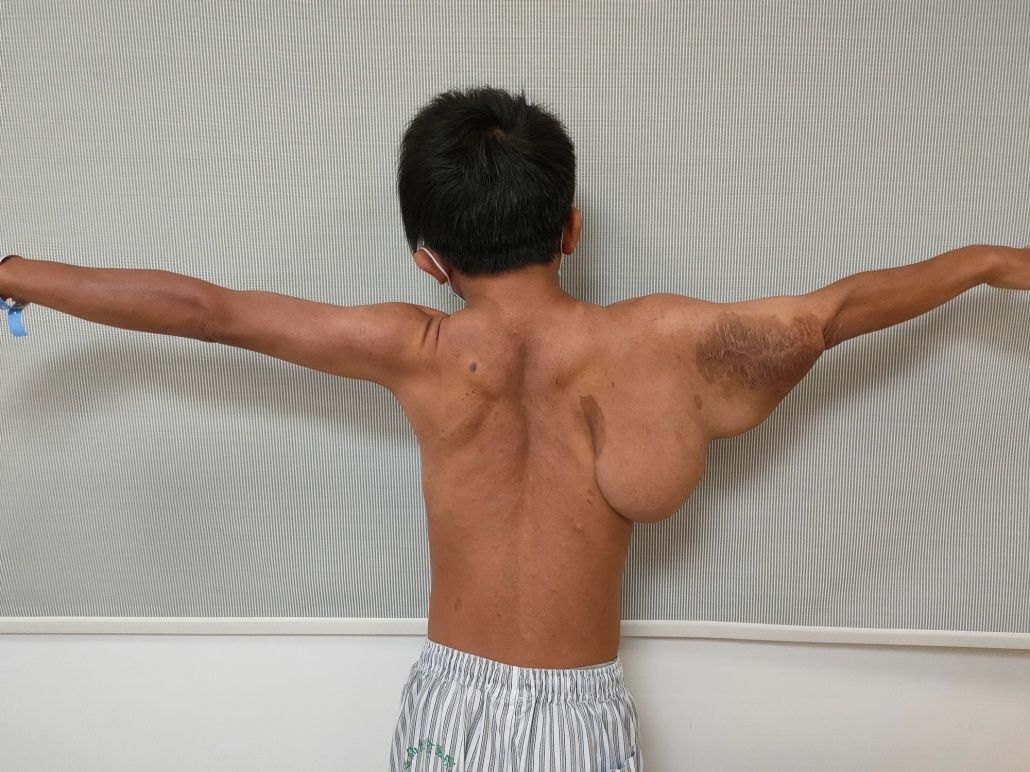  男子肩抗巨大“肉球”生活30余年！医生：警惕皮肤上的咖啡牛奶斑|狐大医 | 张金明教授