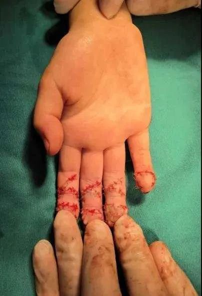 肌腱|妈妈深夜急哭!这个血的教训太惨痛,家长们千万要看住孩子