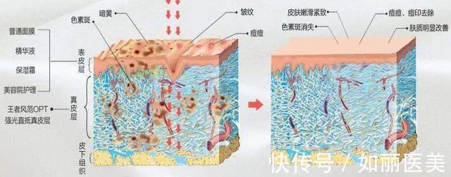 皮肤 想要皮肤好,医美还是护肤品?光子嫩肤的体检报告