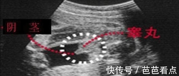 孕囊|记住了!四维单子上有这3个亮点和男女有关