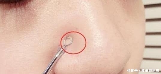 女生鼻子上能挤出“毛毛虫”?教你3个小妙招,远离“草莓鼻”!