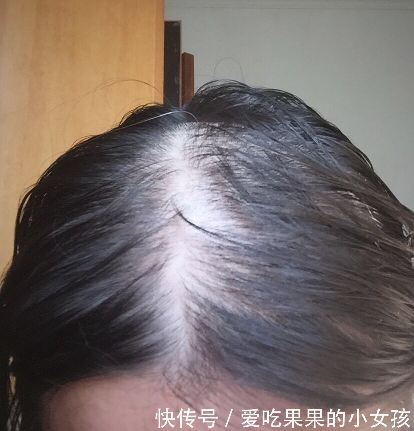 元素|掉发、发质干枯、头发长得慢专家很可能是身体缺乏这些元素
