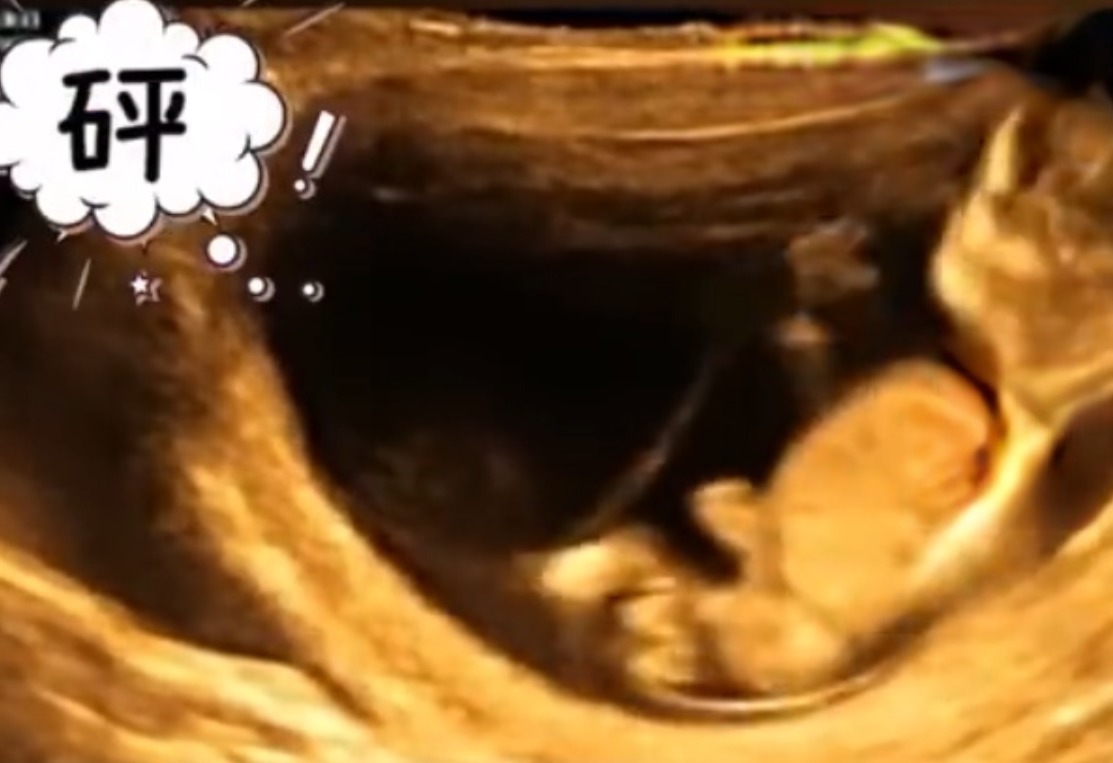 肚子|孕妈做四维彩超时突然腹痛,B超显示让人忍俊不禁,网友:挺无辜