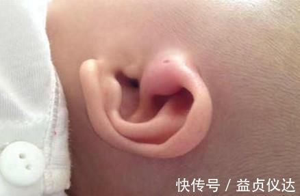局部|宝宝耳朵上有个洞, 以为是好事, 知道真相, 妈妈懵了