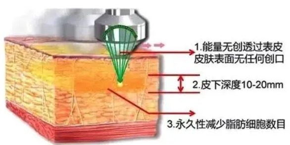 腹部 超脂塑腹部溶脂会有危害吗？属于微创手术吗？适用于哪些部位？