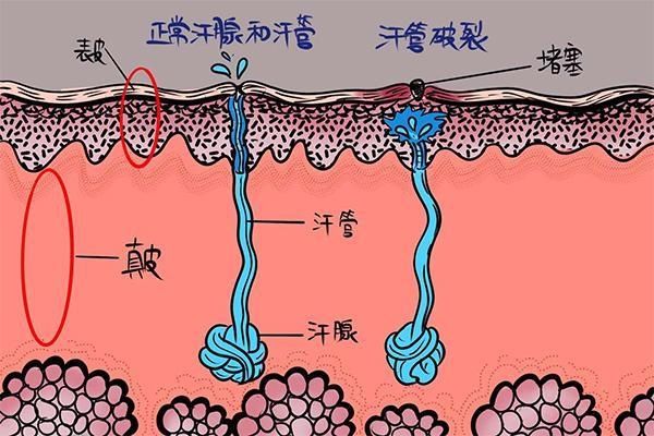 你不知道的人体小秘密——汗腺