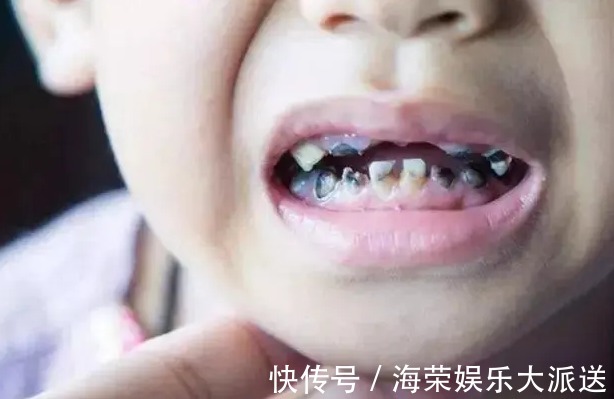 罪魁祸首|妈妈每天偷懒三分钟,3岁女娃竟满口“黑牙”,罪魁祸首不是糖果