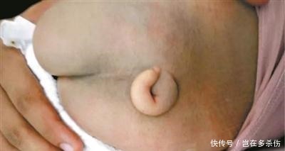 怀孕|新生宝宝竟然长了条小尾巴, 原来是妈妈怀孕时少吃了这个!