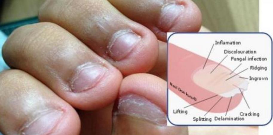 妙招|孩子指甲有白点,有寄生虫?缺维生素?都不是,跟一个坏习惯有关