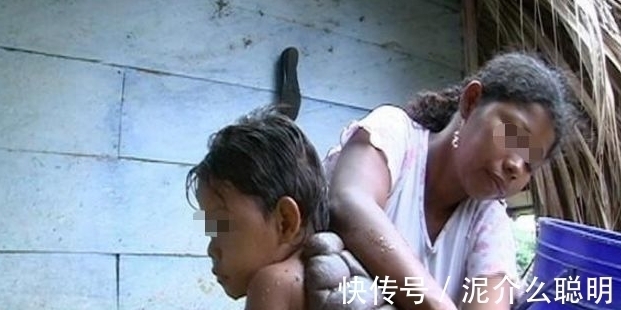 肉瘤|8岁男孩背上长“乌龟壳”,得知真相后,旁人感到心疼不已