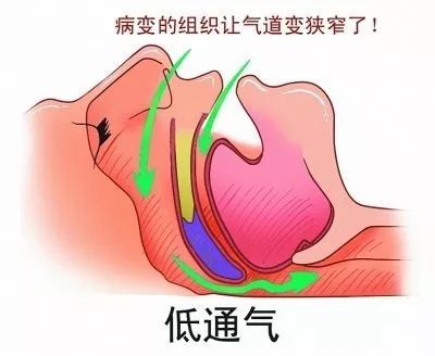 鼾症|打鼾的人注意！呼噜声越大，越要抓紧看