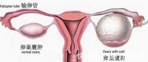 卵巢囊肿|16岁少女剧烈腹痛,B超检查后,医生却说快喊你家长来!