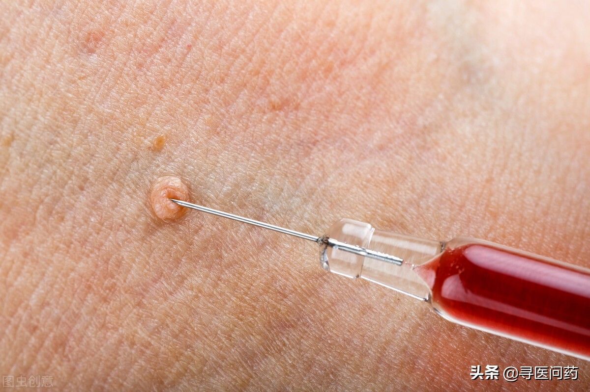 脖子|脖子上的小揪揪别拔，当心是HPV感染，越拔越多