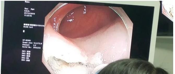 内镜|胃镜查出来“上皮内瘤变”，是癌吗？该怎么办？