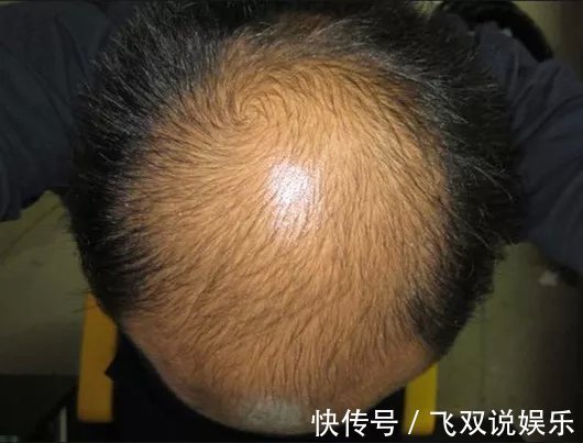 脾虚|中医坦言脾虚的人,至少4毛病!记住3个妙方,让脾胃强大起来