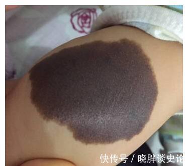 小女孩|宝宝的胎记怎么来的？产科医生：孕期这2种行为易长胎记，要避开