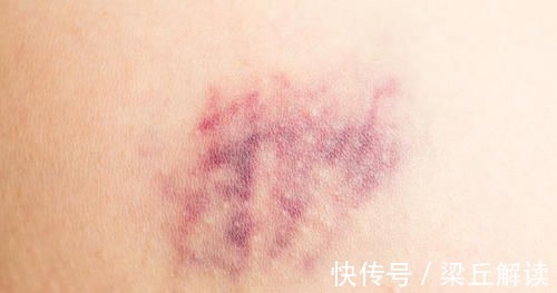 症状|有些症状不可忽视,可能是肺癌的肺外表现,早诊断早治疗痛苦小