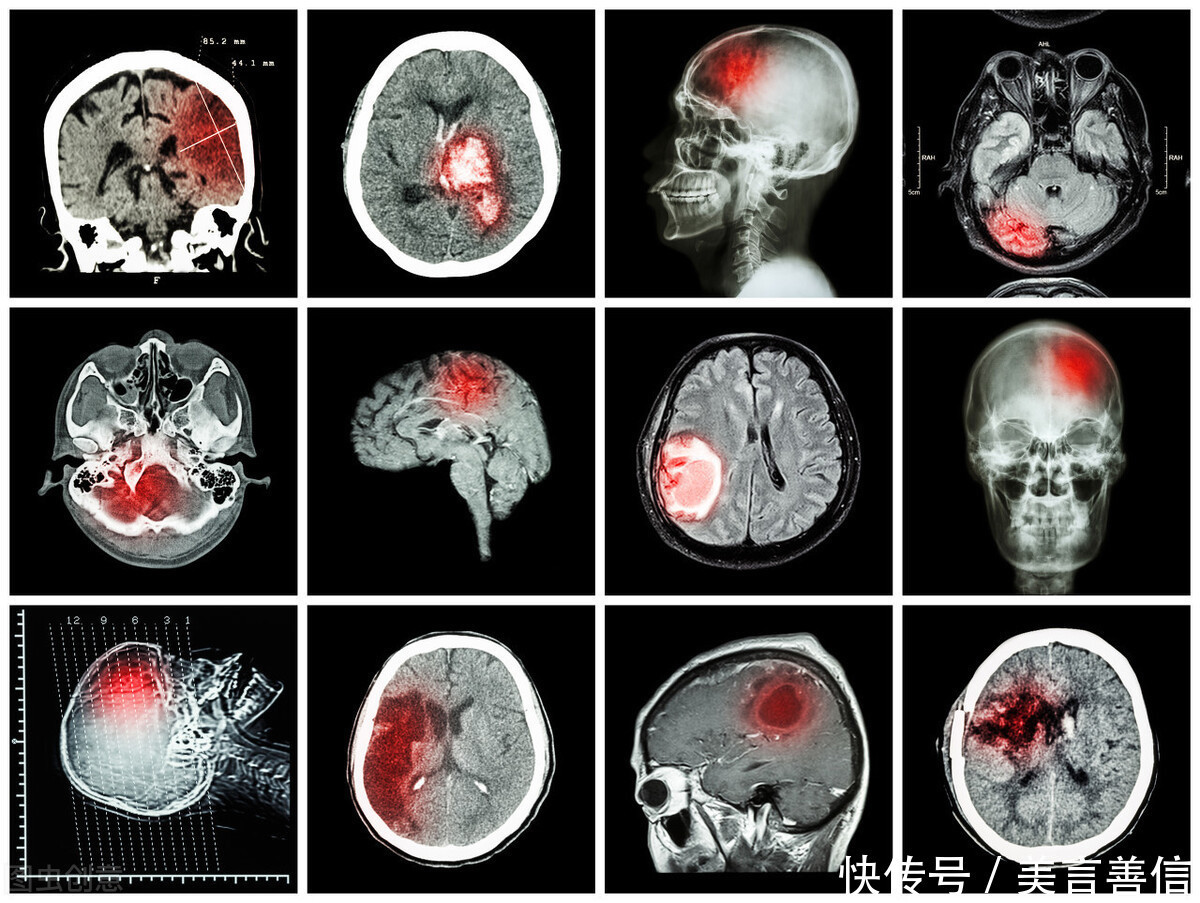 是因为|为什么现在那么多人会患脑梗、脑出血?原来是因为这4个原因