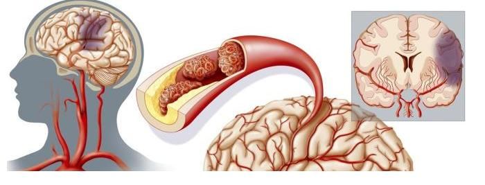 男子|吃一次等于喝“一桶油”,57岁男子查出脑梗塞,因经常吃2种早餐