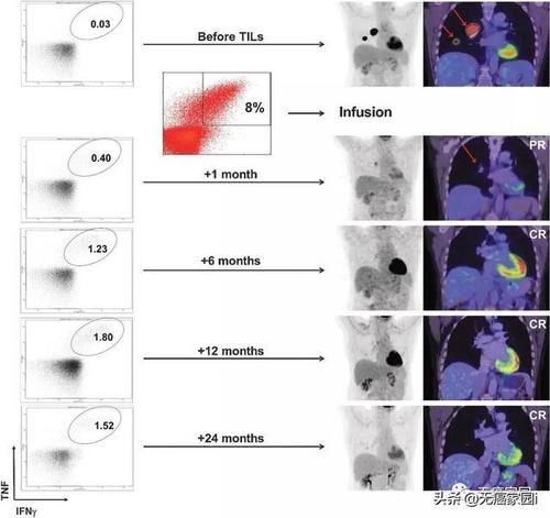 癌细胞从内部消失？TILs疗法用自身细胞杀死肿瘤，晚期患者还有救