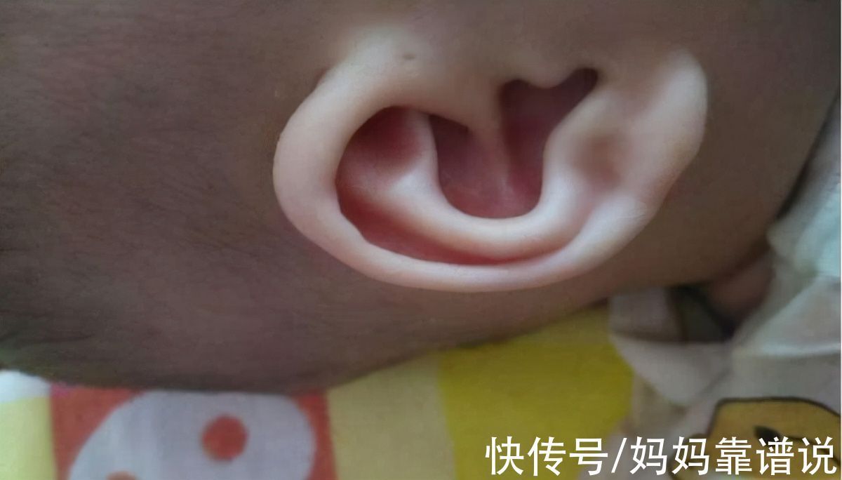 小孔|3岁男童耳边长“聪明孔”,奶奶用手挤,却害了孩子