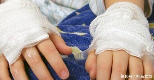 安全意识|4岁宝宝掉入170度油锅,奶奶3步救下孩子,医生:急救措施很专业