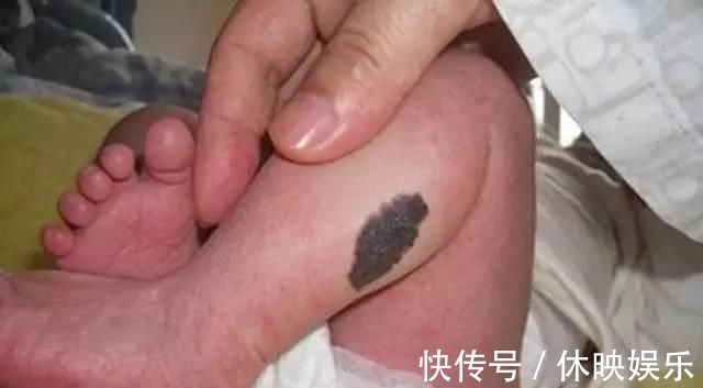 皮肤病|发现新生儿小屁屁上有“淤青”,老公想找护士理论,最后暗暗庆幸