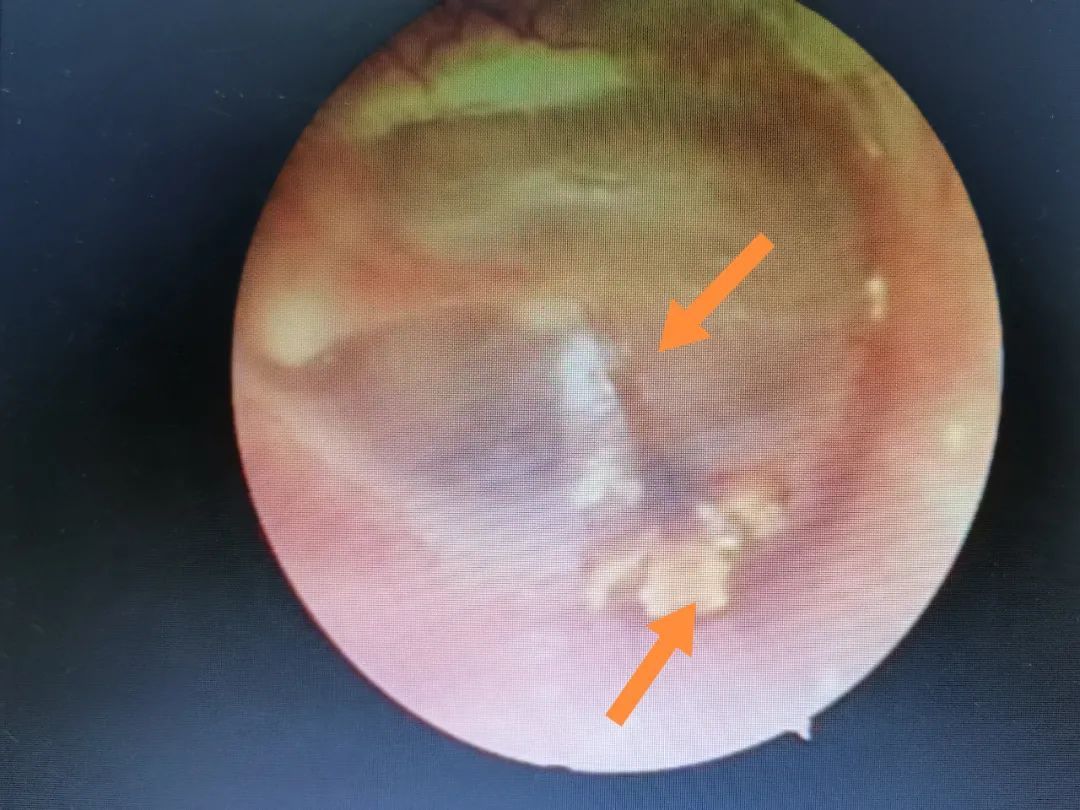 耳鼻咽喉科|平湖小伙耳鸣一周，竟是耳朵里有朵花