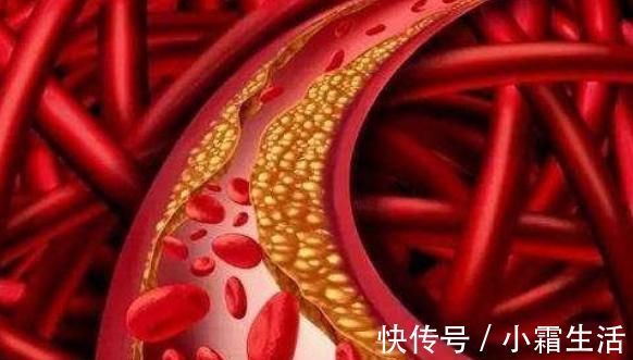 血管堵塞|黑木耳、洋葱能清理血管“垃圾”?今天告诉你真相是什么,认真看